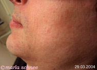 Haarentfernung Laser: Bartschatten nach 2 Behandlungen