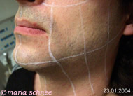 Haarentfernung Laser: Bartschatten vorher