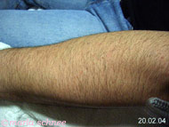Haarentfernung Laser: Unterarm vorher